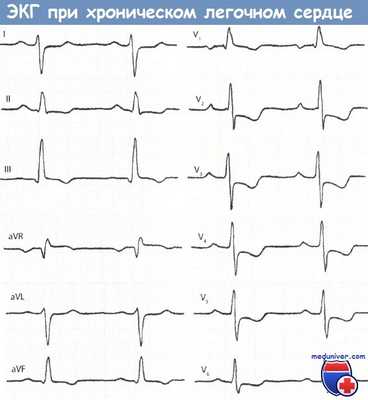 ЭКГ при хроническом легочном сердце