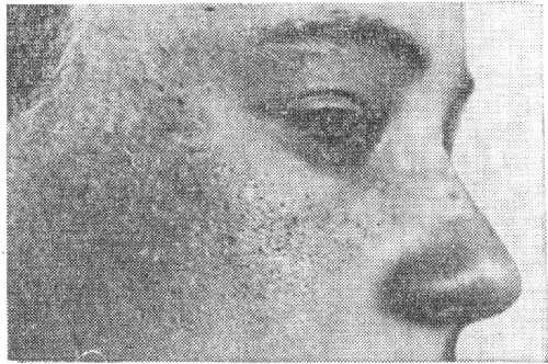 Червеобразная атрофия. Видны атрофические рубчики.