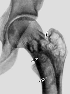 Рис. 1. Рентгенограмма левого тазобедренного сустава больного с болезнью Педжета: структура межвертельной области бедренной кости имеет грубый вид, ячейки (указаны стрелками) между костными перекладинами крупные, неправильной формы
