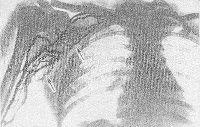 Флебограмма бассейна правой подключичной вены при синдроме Педжета — Шреттера: подключичная и подмышечная вены не контрастированы, видна сеть расширенных коллатералей (указаны стрелками).