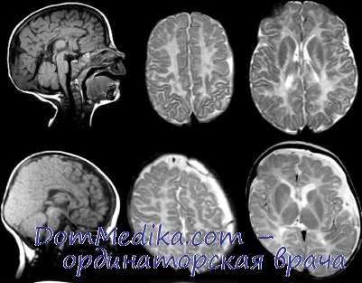 болезнь пелицеуса-мерцбахера