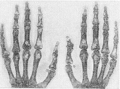 Рис. Рентгенограмма кистей рук больного, страдающего болезнью Юнглинга (прямая проекция): видны множественные очаги просветления в области метафизов пястных костей и фаланг пальцев.