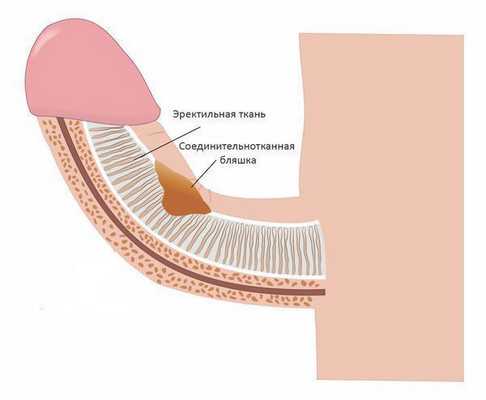 Соединительнотканная бляшка (болезнь Пейрони)