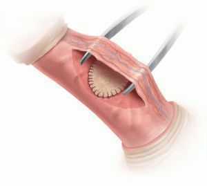 Удлиняющая методика