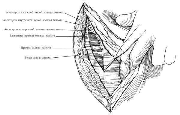 Производят дугообразный разрез влагалища прямой мышцы живота электроножом