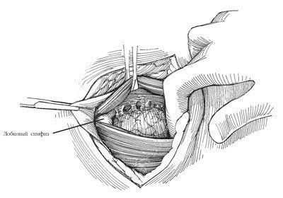 Рассекают и отводят истонченную поперечную фасцию по срединной линии