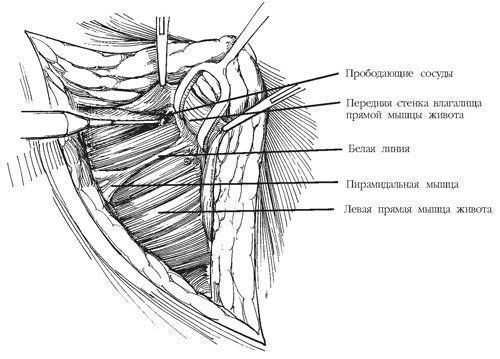 Зажимом Кохера поднимают верхний край влагалища прямой мышцы живота и электроножом отсекают от белой линии живота