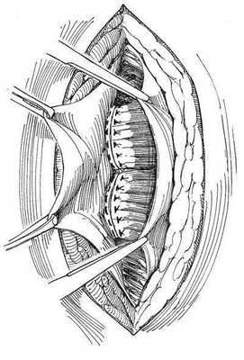 При ушивании раны операционный стол сгибают, чтобы достичь расслабления прямых мышц живота