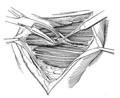 Между прямыми и пирамидальными мышцами рассекают или разводят зажимом поперечную фасцию