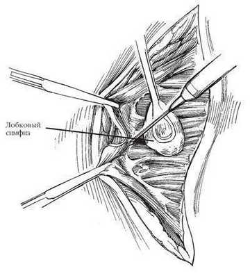 По нижнему краю разреза тупым путем отсепаровывают влагалище прямой мышцы живота от белой линии