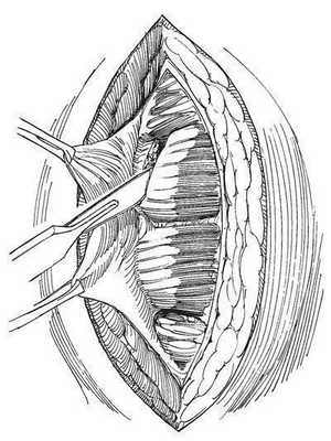 Обнажают сухожильные перемычки прямой мышцы живота в нижней части раны
