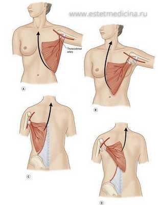 Ротация мышцы при Синдроме Поланда