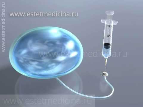 Протез Бейкера