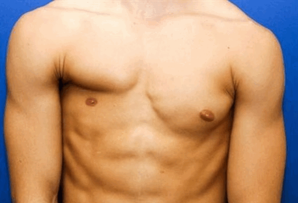 Отсутствие груди