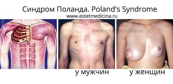 Синдром Поланда у мужчин и женщин