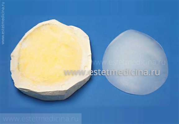 Синдром Поланда: имплант фото