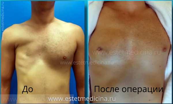 Синдром Поланда: операция фото до и после