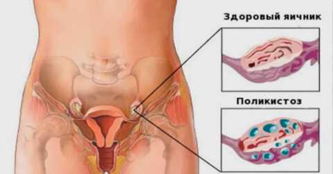 Поликистоз яичников