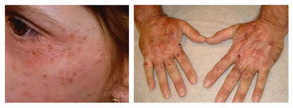 Болезнь Гюнтера (порфирия)