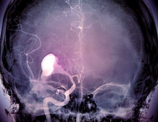 аневризма мозга