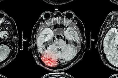 МРТ при черепно-мозговой травме
