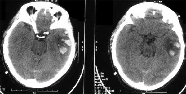 Картинки по запросу сотрясение головного мозга мрт