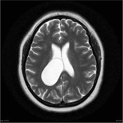 Киста мозга
