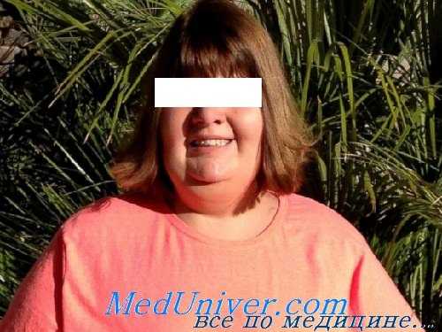 Синдром Прадера-Вилли (СПВ)