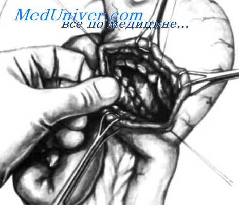 кровотечение из гастроеюноанастомоза