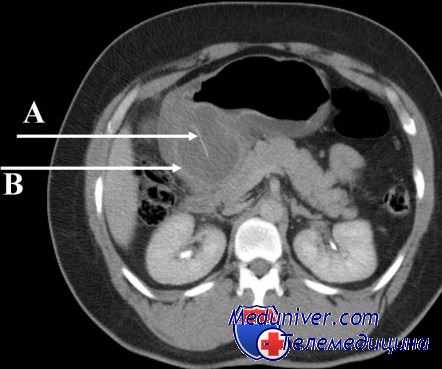 синдром приводящей петли