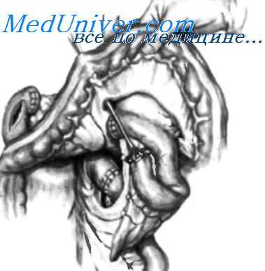 изменение типа резекции желудка