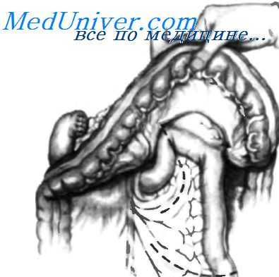 перевод резекции желудка