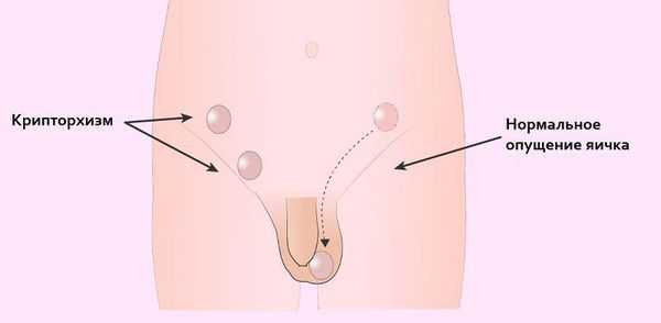 Крипторхизм