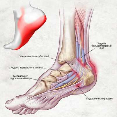 Боль при синдроме тарзального канала
