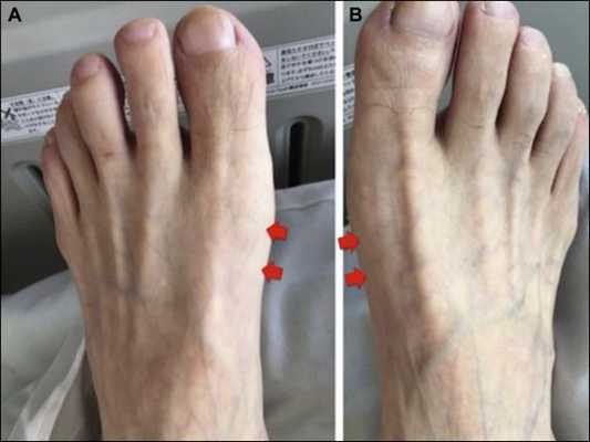 Молоткообразная деформация пальцев