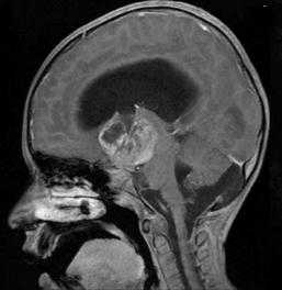 Расселла диэнцефальный синдром_МРТ головы