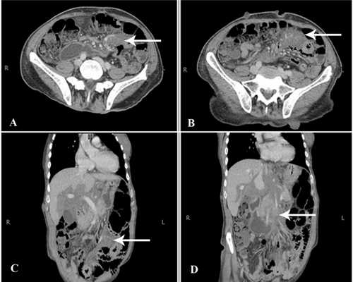 нейрофиброматоз у детей