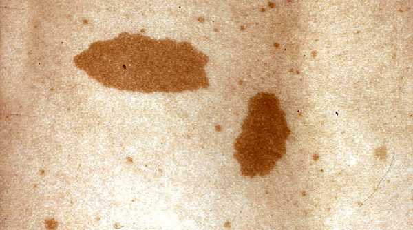 Пигментные пятна