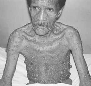 множественные нейрофибромы