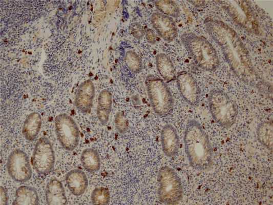 нейрофиброматоз первого типа болезнь реклингхаузена где леча