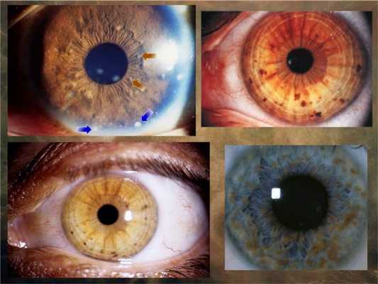 Пятна на радужке при нейрофиброматозе