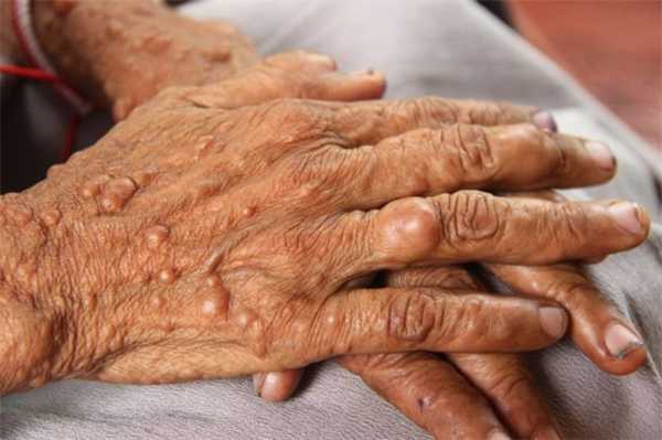 синдром реклингхаузена