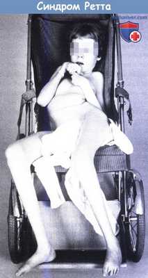 Синдром Ретта