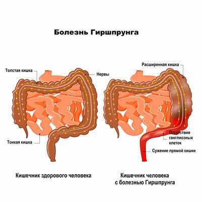 Синдром Рейно