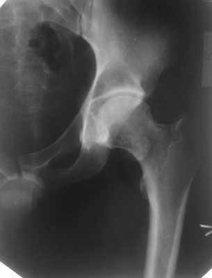 Остеохондрома шейки бедренной кости, хондроматоз тазобедренного сустава