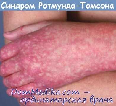 синдром Ротмунда-Томсона