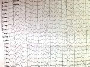 ЭЭГ при синдроме Рубинштейна - Тейби