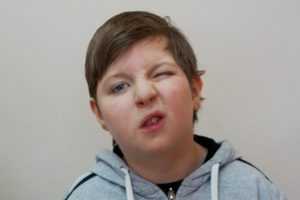 стереотипии при синдроме Рубинштейна - Тейби