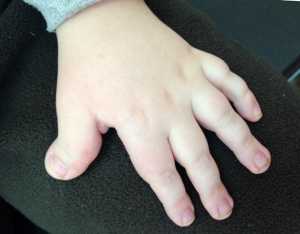 кисть при синдроме Рубинштейна - Тейби