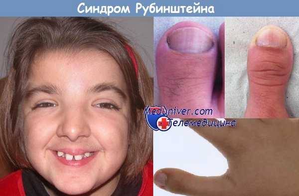 синдром Рубинштейна